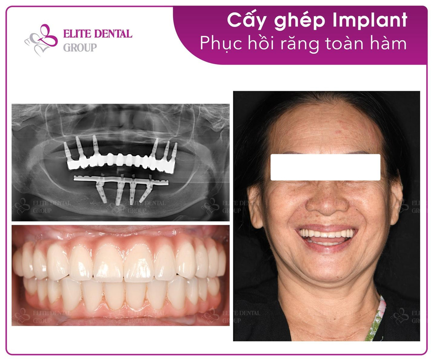 Hình ảnh của bệnh nhân trước và sau khi thực hiện phương pháp ProArch từ nghiên cứu của TS.BS Trần Hùng Lâm. Hình ảnh của bệnh nhân trước và sau khi thực hiện phương pháp ProArch từ nghiên cứu của TS.BS Trần Hùng Lâm.