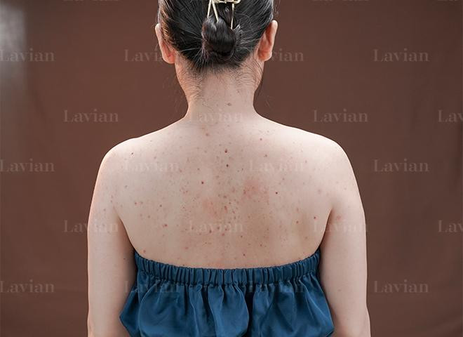 Làn da bị viêm cấp độ 2 Làn da bị viêm cấp độ 2