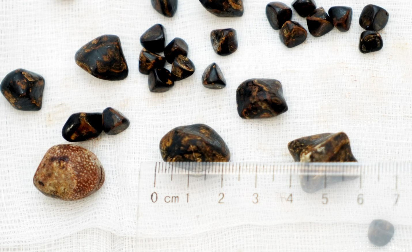 Kích thước sỏi được gắp ra từ túi mật bệnh nhân