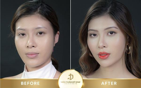Khử thâm môi tại Viện thẩm mỹ DIVA