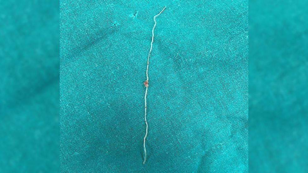 Con giun trong má bệnh nhân. Ảnh: RT