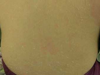 Sau khi bôi kem tắm trắng khoảng 1 giờ, V bỏng rát toàn thân. 