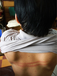 Vết thương bầm tím trên lưng thầy Lộc. Ảnh: Đ.Tuyên (Tuổi Trẻ). Vết thương bầm tím trên lưng thầy Lộc. Ảnh: Đ.Tuyên (Tuổi Trẻ)