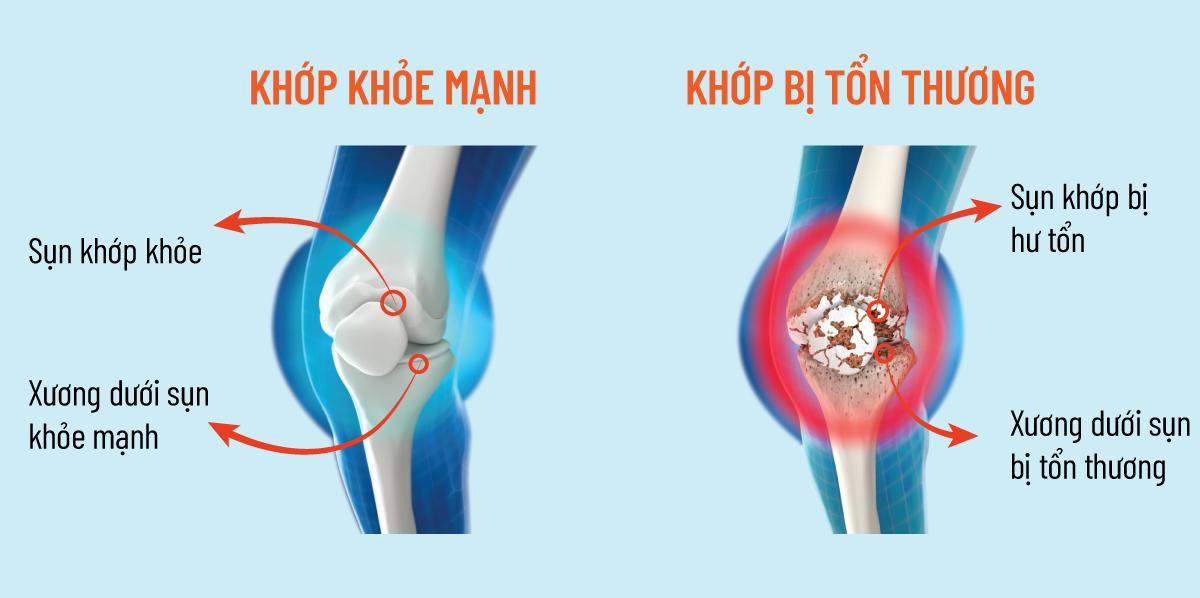 Sụn khớp bị tổn thương trước sự phá hủy của các yếu tố gây viêm