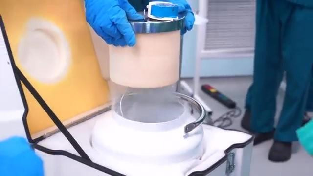 Đoạn u xương được xử lý bằng ni tơ hóa lỏng để diệt tế bào ung thư trước khi ghép trở lại cho người bệnh Đoạn u xương được xử lý bằng ni tơ hóa lỏng để diệt tế bào ung thư trước khi ghép trở lại cho người bệnh