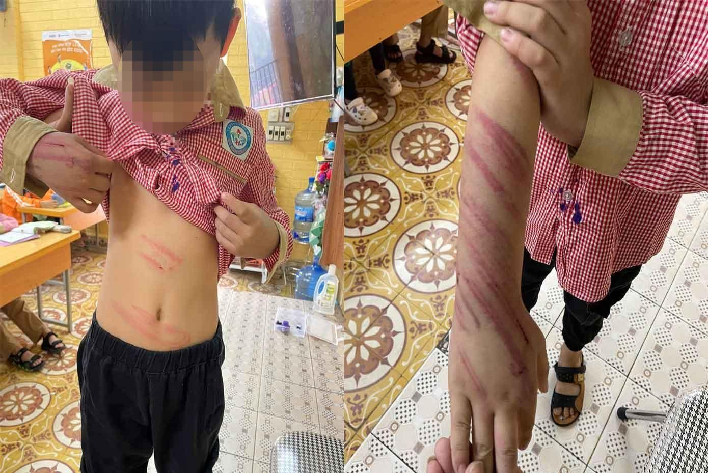 Bé trai Trương G.B với nhiều vết bầm tím trên người Bé trai Trương G.B với nhiều vết bầm tím trên người