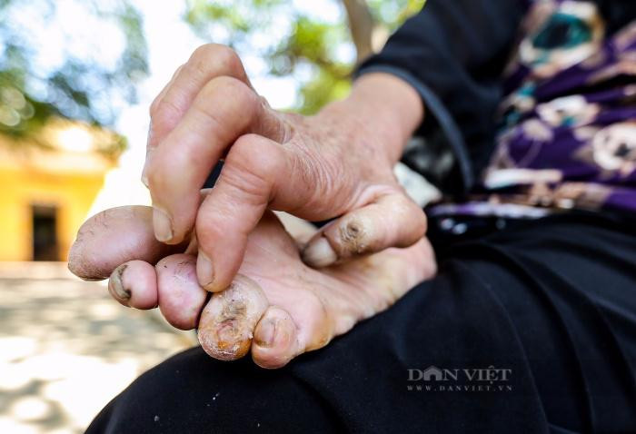 Di chứng của bệnh phong. Ảnh: Gia Khiêm