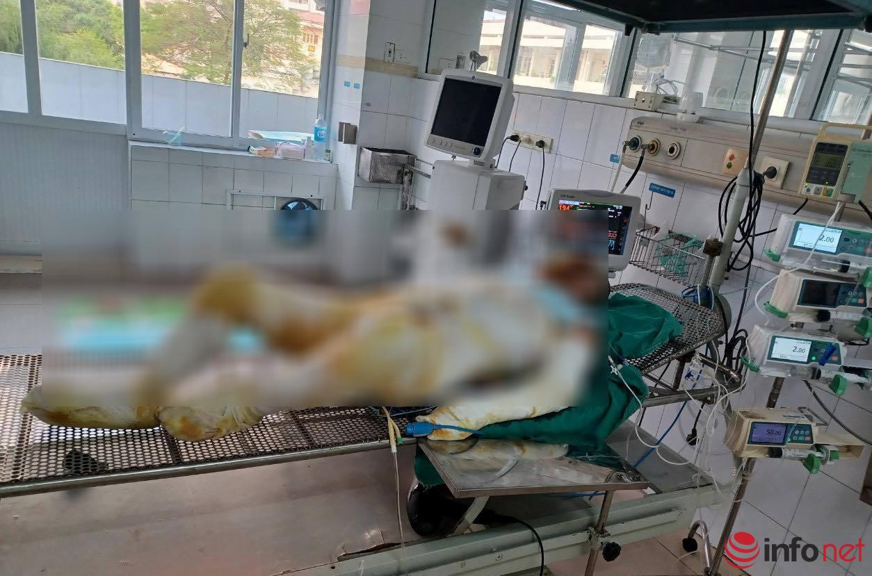 Bà Đều bị bỏng tới 80%, hiện đang điều trị tại Viện Bỏng Quốc gia. (Ảnh: Gia đình nạn nhân cung cấp)