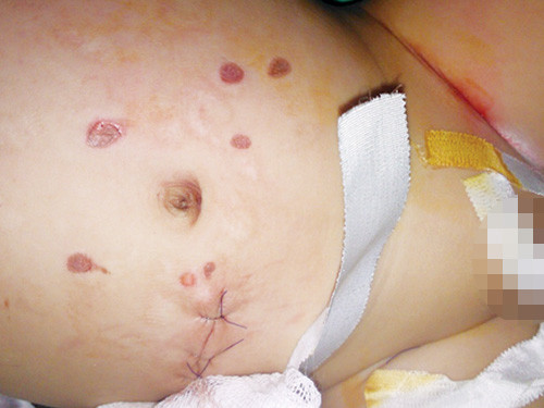 Nhiều vết đốt gây phỏng da cháu Tuấn Anh. Ảnh: M.T. Nhiều vết đốt gây phỏng da cháu Tuấn Anh. Ảnh: M.T