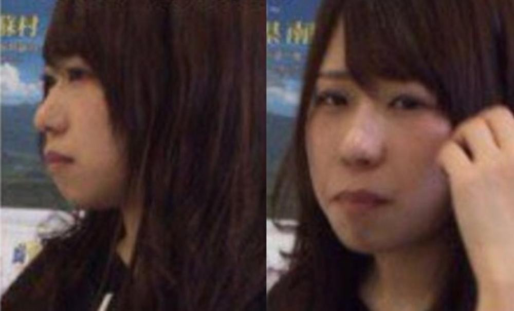 Mikishi sau phẫu thuật mắt hai mí.