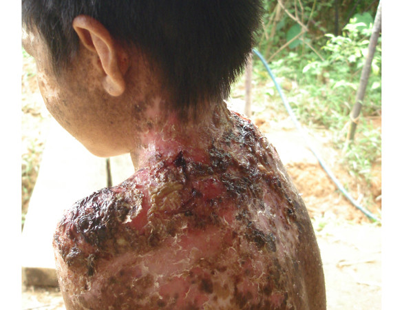 Vết lở loét trên người em Xa Văn Tâm, ở 