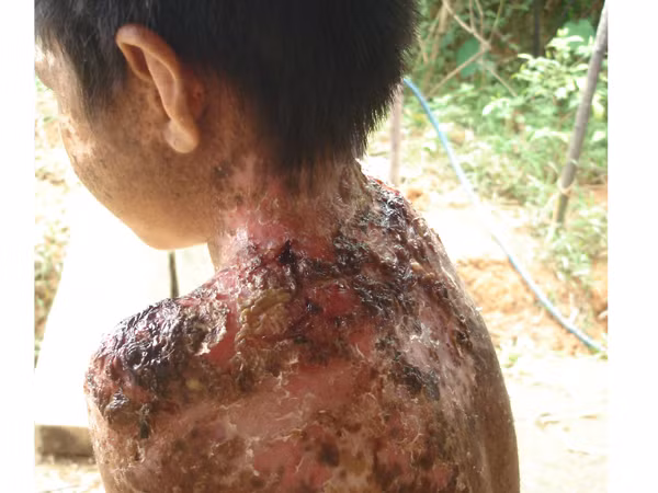 Vết lở loét trên người em Xa Văn Tâm, ở 