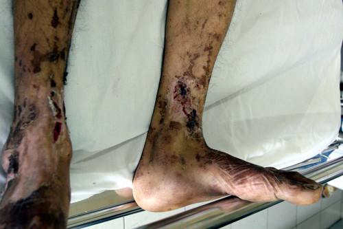 Mất mạng do ăn... tái, sống ảnh 1