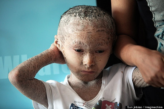 Ngay từ khi chào đời, các bác sĩ chẩn đoán bé mắc một chứng bệnh hiếm có tên gọi là Ichtyosis, hay còn gọi là bệnh da vảy cá