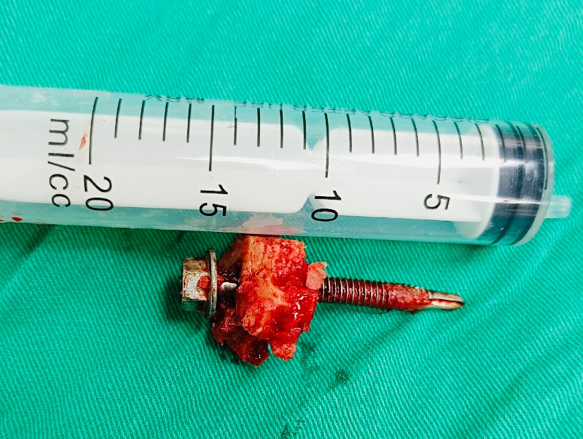 Dị vật được lấy ra