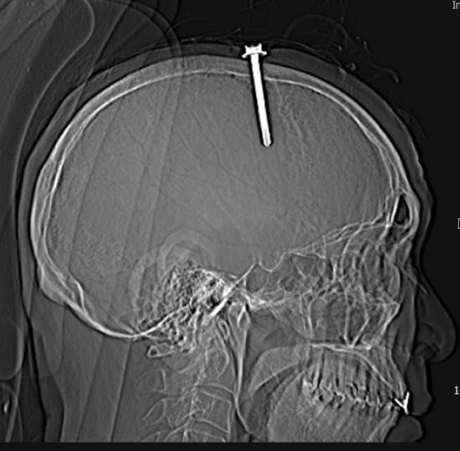 Vị trí dị vật đâm xuyên