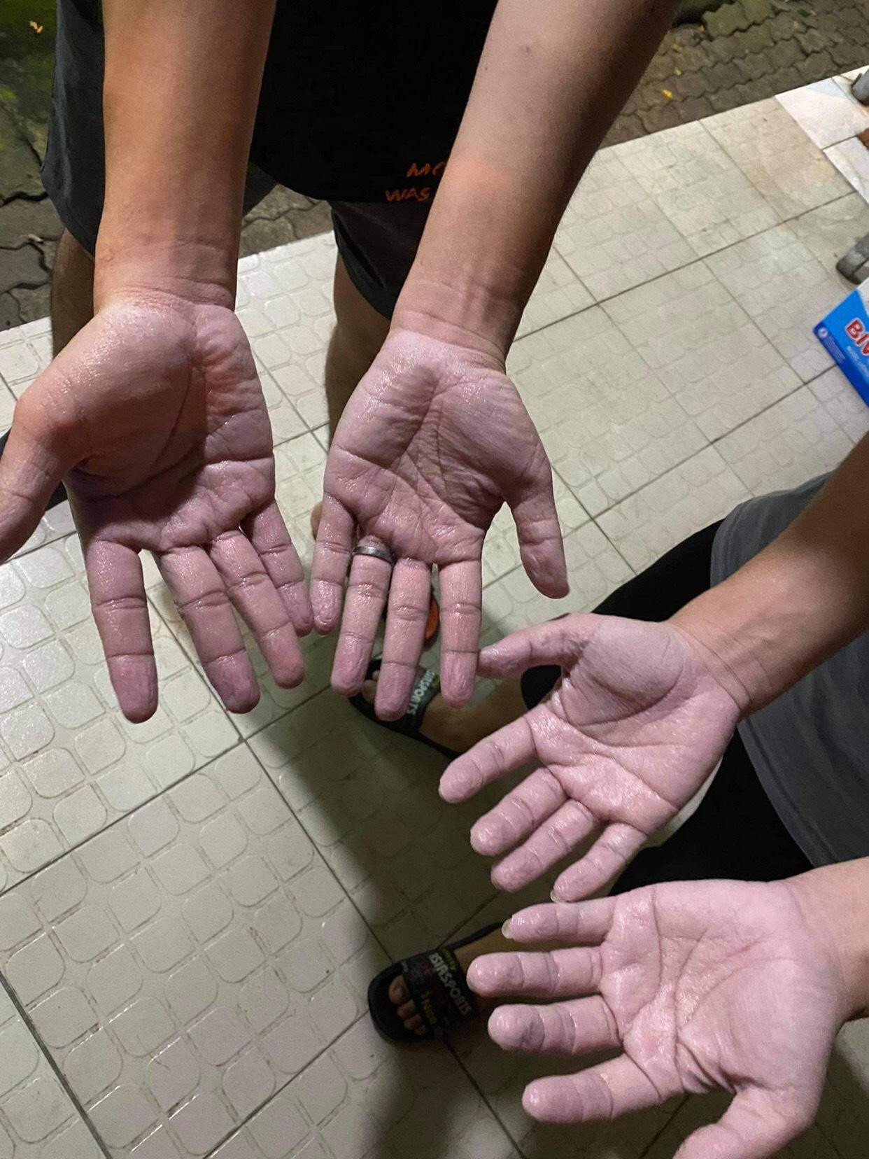 Đôi bàn tay nhăn nhúm vì phải đeo găng tay bảo hộ cả ngày.