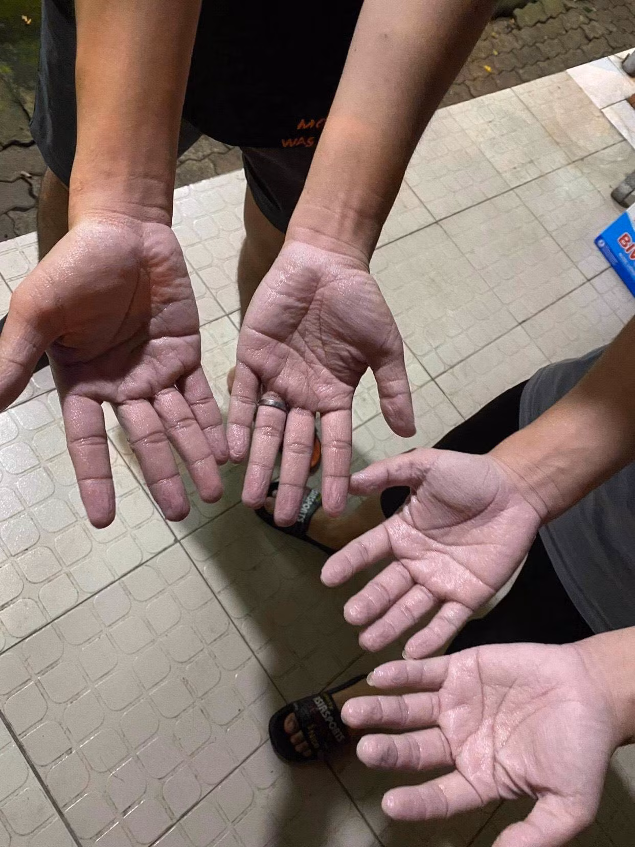 Đôi bàn tay nhăn nhúm vì phải đeo găng tay bảo hộ cả ngày.