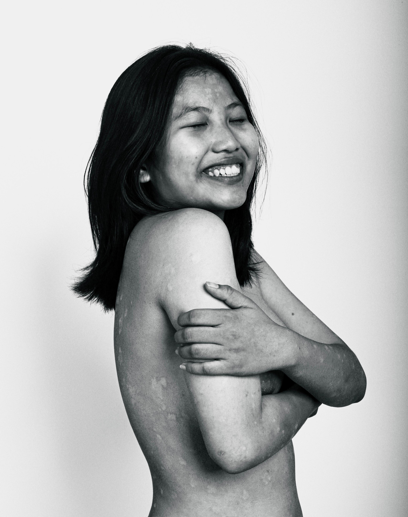 Từng vết đỏ trên da đối với Lan Anh không còn là nỗi tự ti mà là những lời nhắc mang thông điệp: “Hãy yêu chính bản thân mình”. (Ảnh: NVCC) Từng vết đỏ trên da đối với Lan Anh không còn là nỗi tự ti mà là những lời nhắc mang thông điệp: “Hãy yêu chính bản thân mình”. (Ảnh: NVCC)