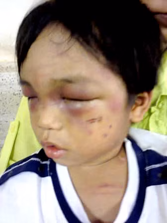 Những vết thương chằng chịt trên mặt và khắp thân thể cháu bé 3 tuổi