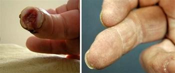 Ngón tay bị cụt đã được tái tạo lại. Ngón tay bị cụt đã được tái tạo lại.