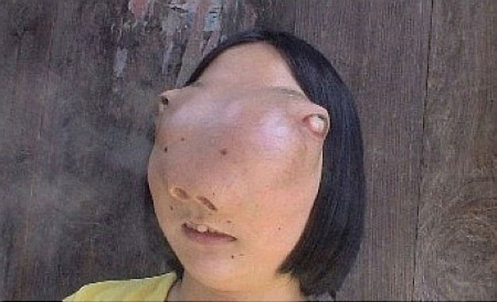 Cô gái 22 tuổi Ngô Tiểu Yến ở tỉnh Triết Giang (Trung Quốc). Từ khi lên 9, Tiểu Yến đã được phát hiện mắc bệnh nan y biến chứng, kích thước khối u trên mặt đè nén dây thần kinh dẫn tới khiếm thị