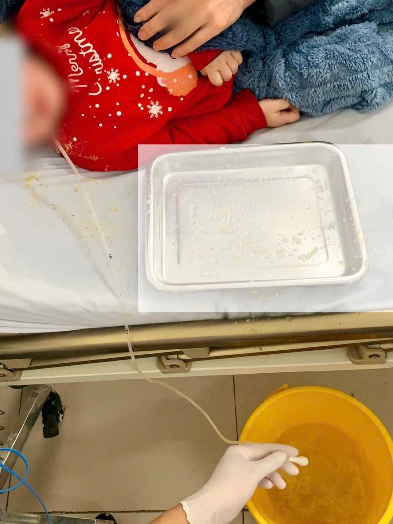 Bé được tiến hành đặt ống xông dạ dày và rửa dạ dày bằng nước muối sinh lý trong khoảng 15 phút, cho đến khi dịch dạ dày trở nên trong. Qua phân tích, dịch dạ dày có chứa thức ăn, một ít thóc và một số dấu hiệu của thuốc chuột. Ảnh bệnh viện cung cấp