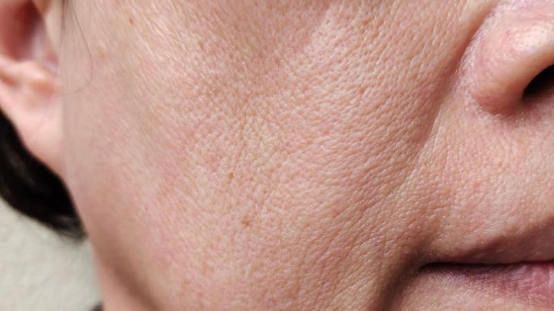 Collagen suy giảm dẫn đến hiện tượng da chùng nhão, xuất hiện nếp nhăn