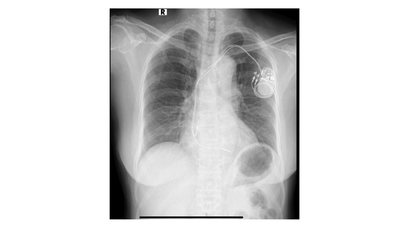 Hình ảnh một ca điều trị rối loạn nhịp tim hiệu quả bằng thiết bị cấy dưới da của bệnh nhân nữ 75 tuổi. Ảnh: Nhật Minh.