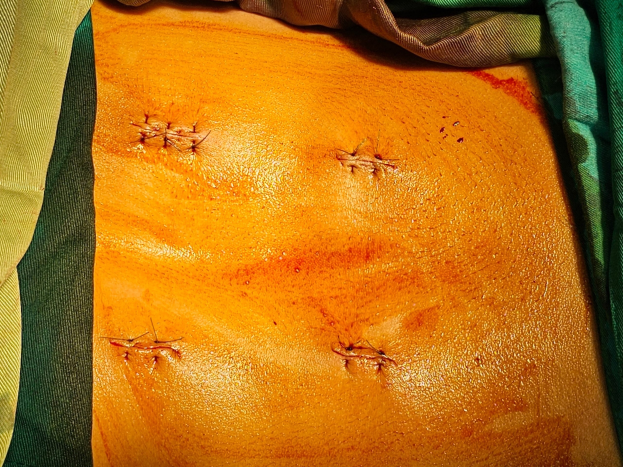 Sau mổ chỉ có 4 vết mổ nhỏ, mỗi vết chỉ khoảng 2cm