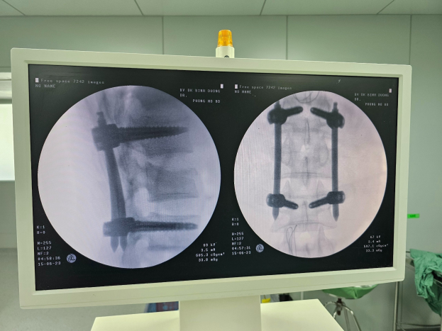 Hình ảnh C-Arm sau mổ gãy cột sống thắt lưng bằng phương pháp bắt vít qua da.