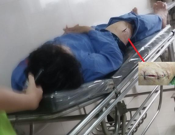 Ông Nguyễn Văn Giản, cán bộ Cục Thuế Ninh Bình bị một đối tượng bịt mặt, đi xe mô tô không biển số tiến đến gần, rút dao đâm vào đùi. Ảnh Long Vân Ông Nguyễn Văn Giản, cán bộ Cục Thuế Ninh Bình bị một đối tượng bịt mặt, đi xe mô tô không biển số tiến đến gần, rút dao đâm vào đùi. Ảnh Long Vân