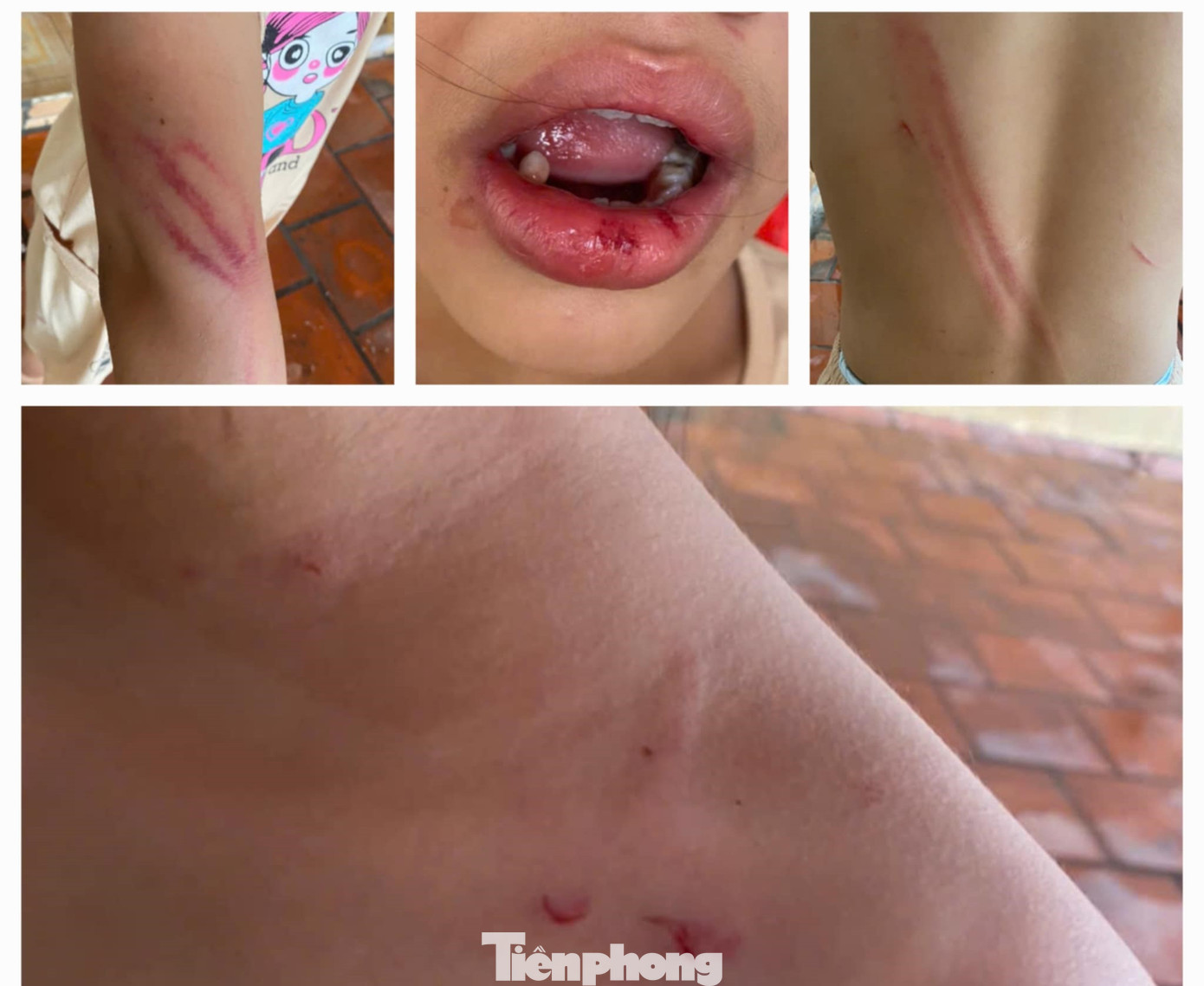 Cơ thể bé gái đầy thương tích