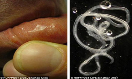 Ấu trùng giun không ngừng di chuyển từ môi sang má của tiến sĩ Jonathan Allen 