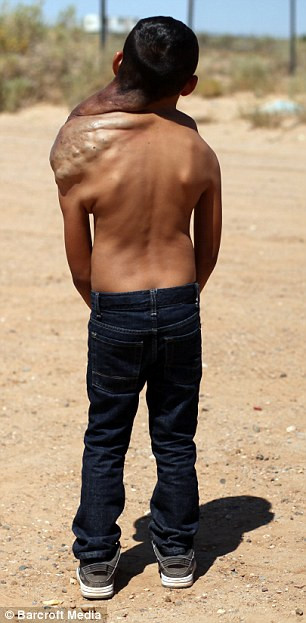 Khối u đang nguy hiểm đến tính mạng nhưng có thể làm teo bằng Viagra sau đó làm phẫu thuật cắt bỏ. Khối u đang nguy hiểm đến tính mạng nhưng có thể làm teo bằng Viagra sau đó làm phẫu thuật cắt bỏ