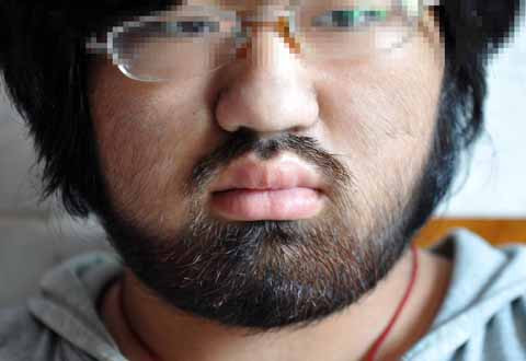 Nana với khuôn mặt đầy lông lá. Ảnh: Rex Features