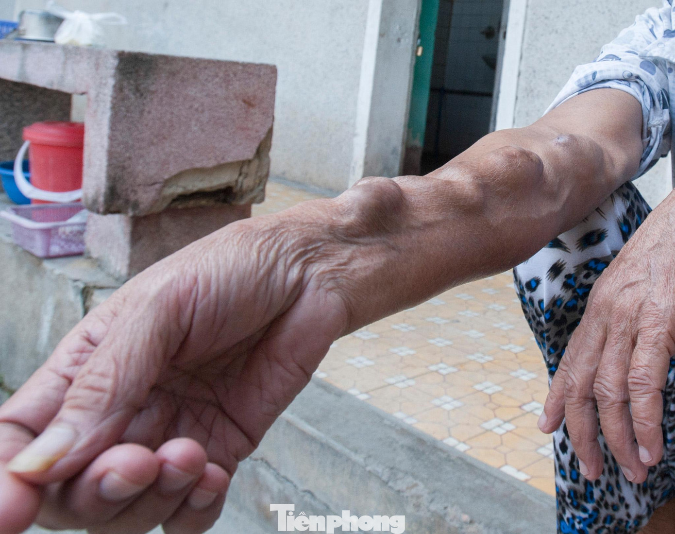 Nỗi đau bệnh tật đeo bám những hoàn cảnh khó khăn nơi xóm trọ chạy thận trong lòng thành phố Vinh.