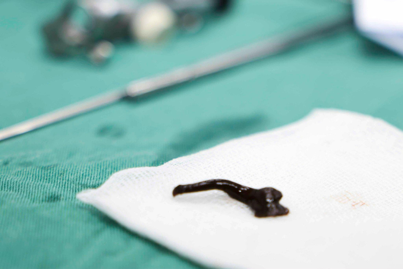 Một con vắt được gắp ra khỏi đường thở bệnh nhi