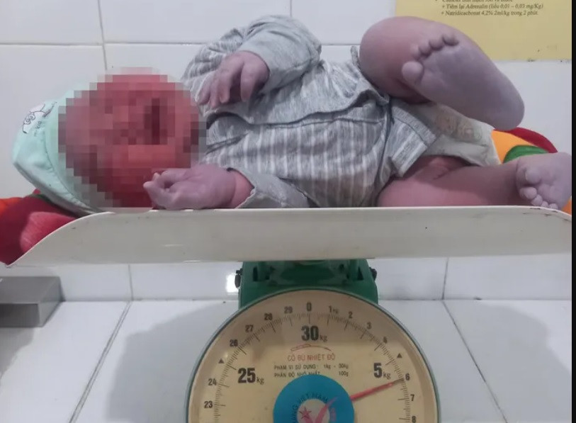 Bé trai nặng 6 kg được mổ thành công.