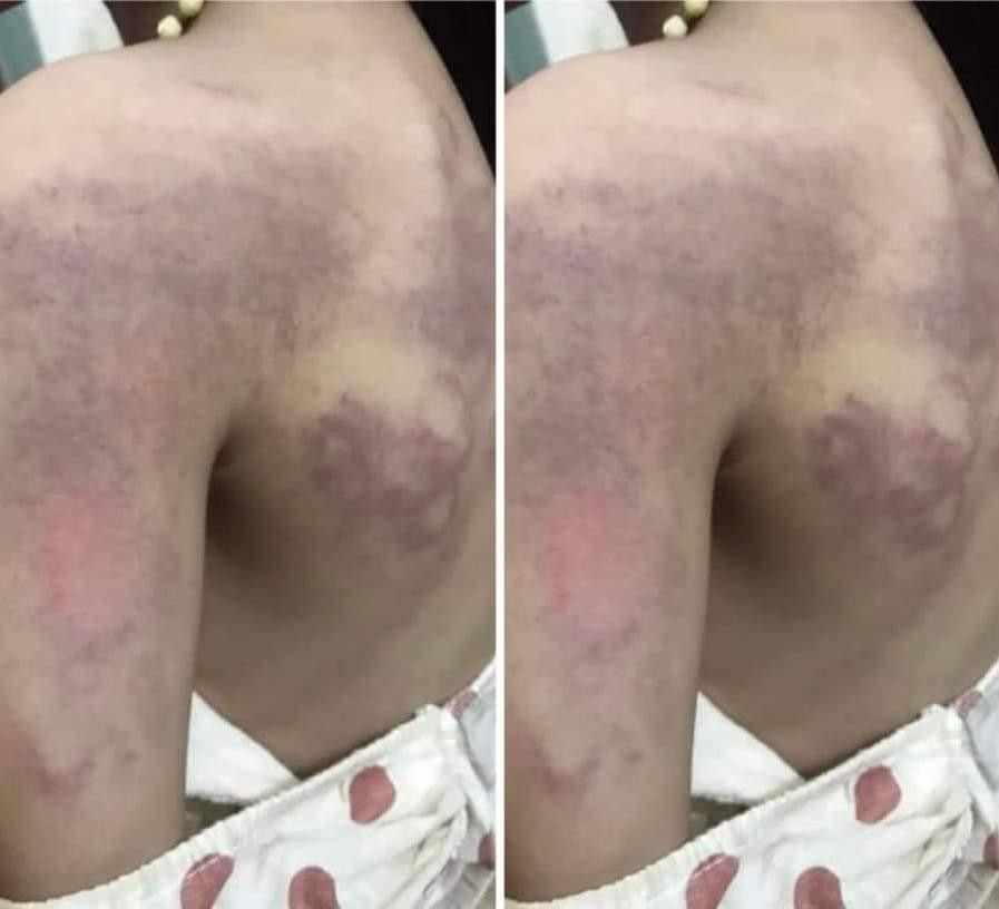 Vết bầm tím sau lưng bé Ph. Vết bầm tím sau lưng bé Ph.