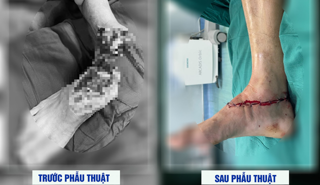 Ca phẫu thuật kéo dài 4 giờ đồng hồ đã nối thành công chân cho bệnh nhân.