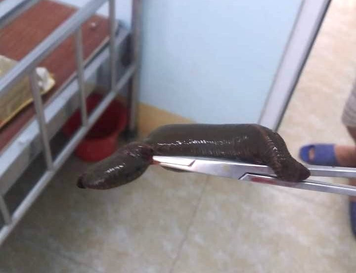 Con đỉa dài 15cm được gắp ra khỏi cơ thể ông T.