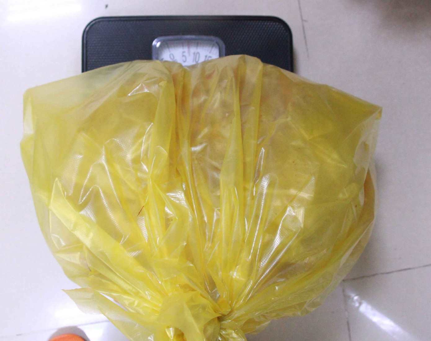 Khối u nặng 7kg được bóc tách khỏi bụng bệnh nhân Khối u nặng 7kg được bóc tách khỏi bụng bệnh nhân