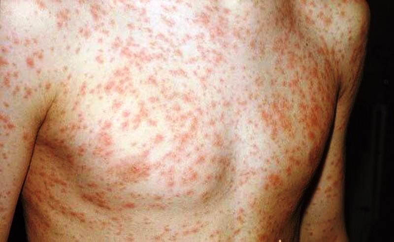 Sởi là bệnh truyền nhiễm nguy hiểm, nguy cơ bùng phát dịch ở mức cao (ảnh minh họa) Sởi là bệnh truyền nhiễm nguy hiểm, nguy cơ bùng phát dịch ở mức cao (ảnh minh họa)