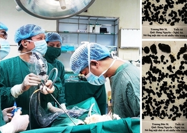 Gần 1.000 viên sỏi đường mật trong gan của bệnh nhân N.Đ.M được bác sĩ lấy ra sau ca phẫu thuật nội soi kéo dài 3 tiếng Gần 1.000 viên sỏi đường mật trong gan của bệnh nhân N.Đ.M được bác sĩ lấy ra sau ca phẫu thuật nội soi kéo dài 3 tiếng