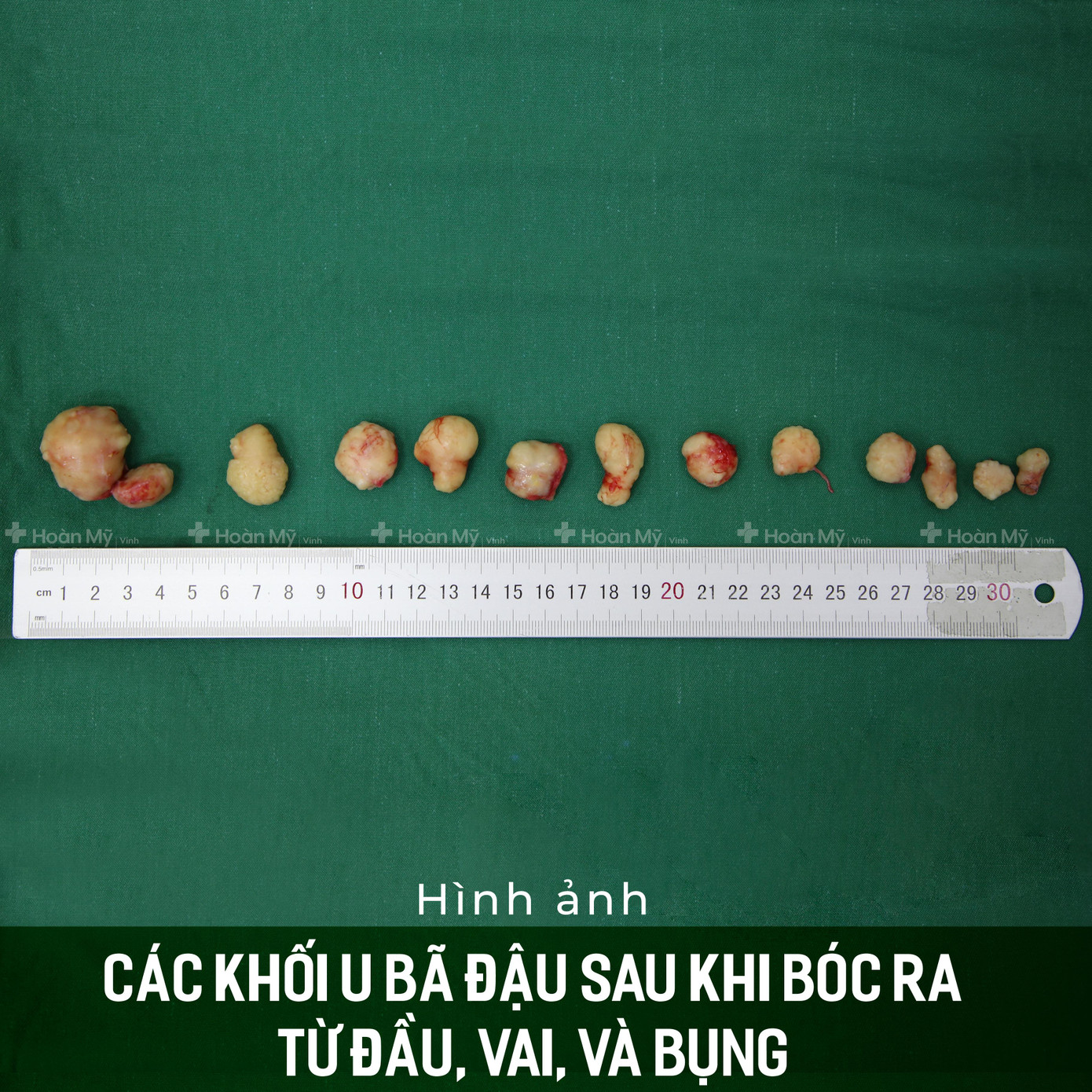 Hình ảnh sau khi phẫu thuật.