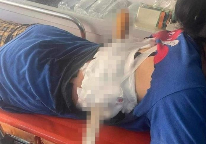 Nạn nhân bị dao xuyên lưng. Nạn nhân bị dao xuyên lưng.