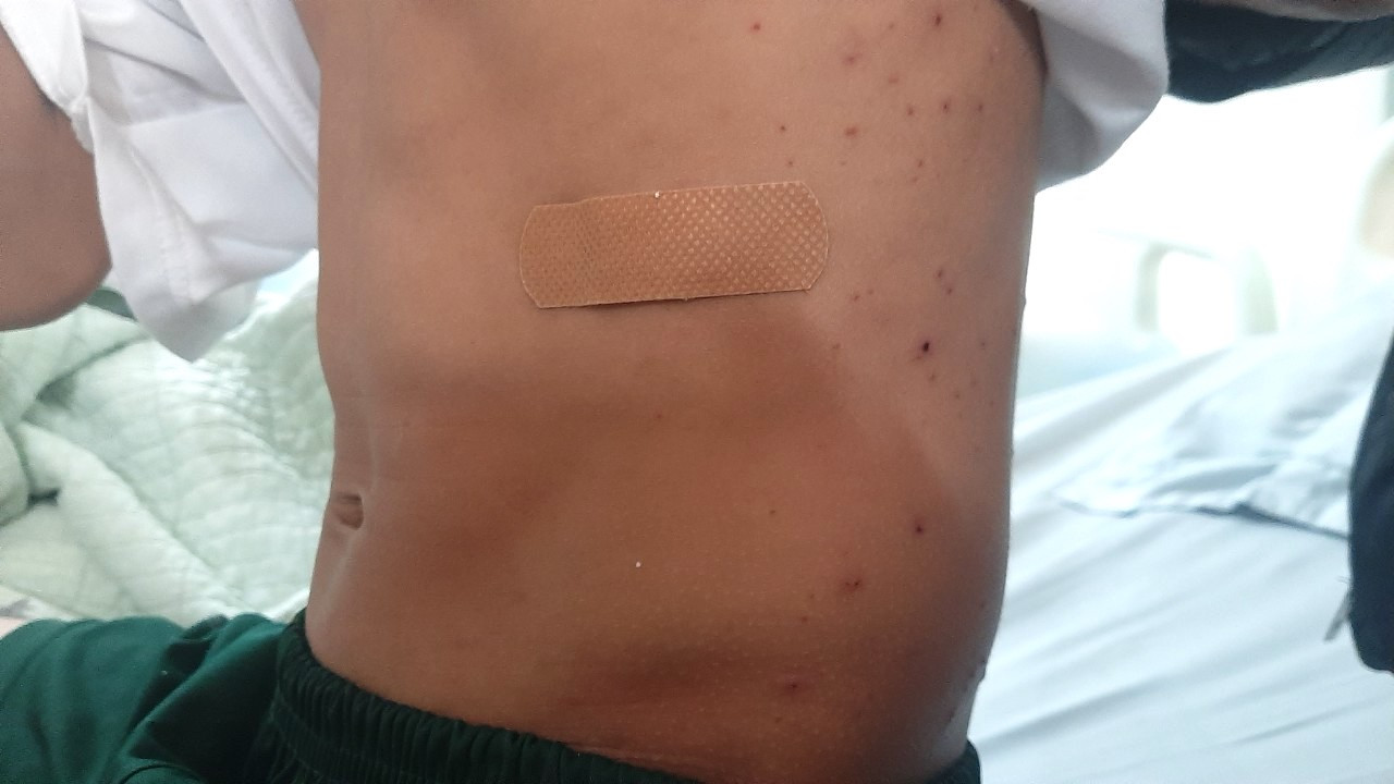 Mảnh vỡ găm chằng chịt ở sườn, cẳng tay cháu Nhật. Mảnh vỡ găm chằng chịt ở sườn, cẳng tay cháu Nhật.