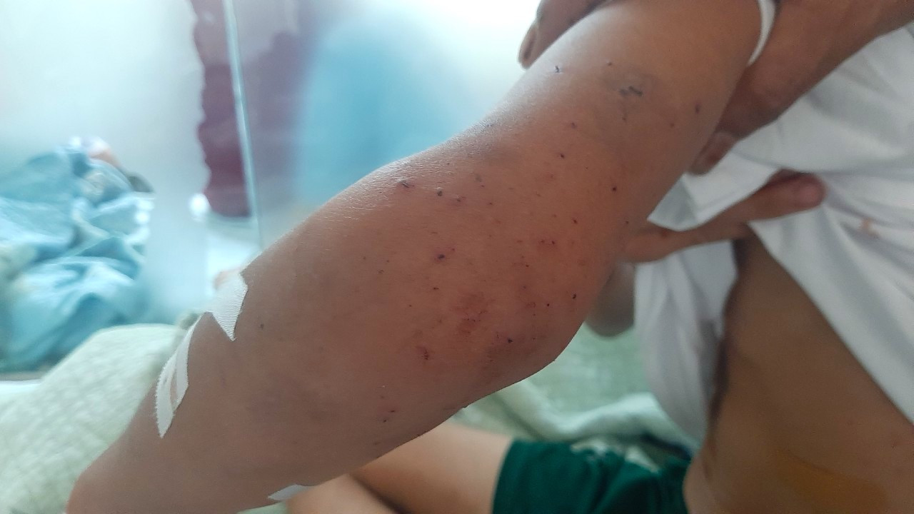 Mảnh vỡ găm chằng chịt ở sườn, cẳng tay cháu Nhật. Mảnh vỡ găm chằng chịt ở sườn, cẳng tay cháu Nhật.