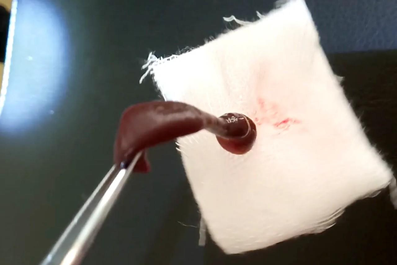 Con đỉa bám trong mũi nam thanh niên.